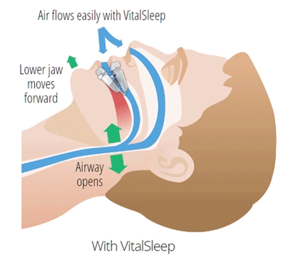 VitalSleep snore diagram
