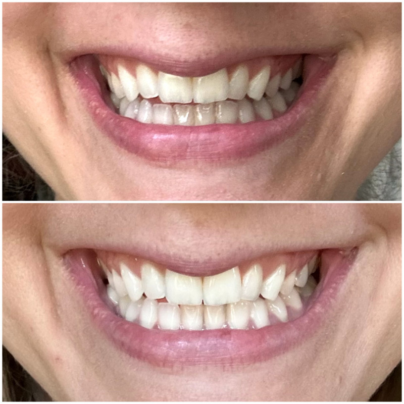 teeth whitening results