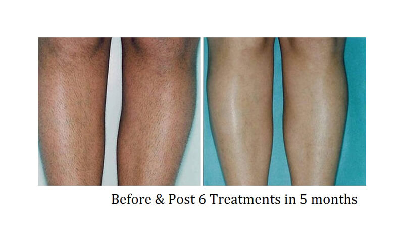 viqure hair removal before and after 