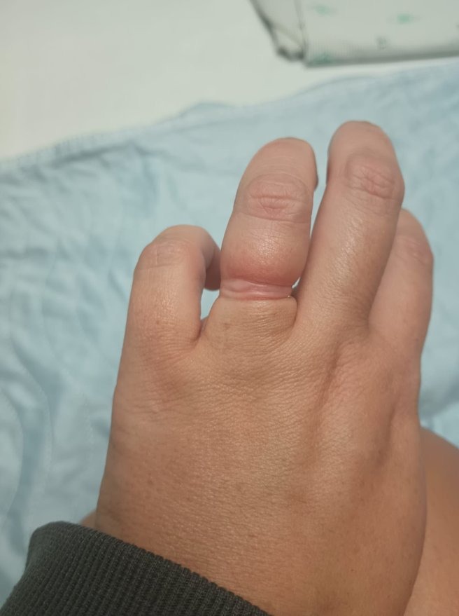 Wedding ring had to be cut off