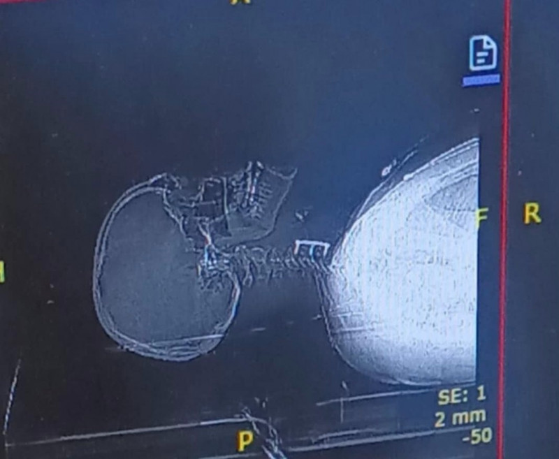 titanium parts in neck